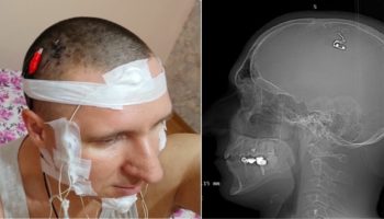 Picture Mikhail Raduga Claims to Have Implanted a Chip in His Head to Control Lucid Dreams