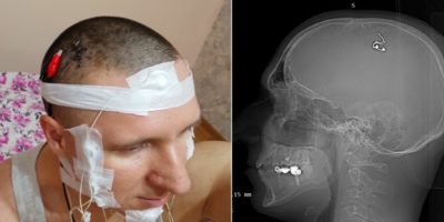 Picture Mikhail Raduga Claims to Have Implanted a Chip in His Head to Control Lucid Dreams