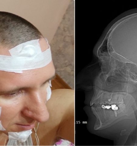 Picture Mikhail Raduga Claims to Have Implanted a Chip in His Head to Control Lucid Dreams