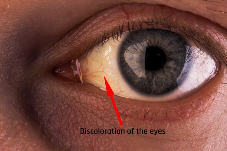 Discoloration of the eyes.