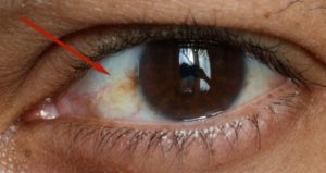 Eye Discoloration