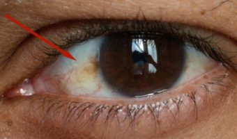 Picture When the White in Your Eyes Is Not Quite White, Should You Worry?