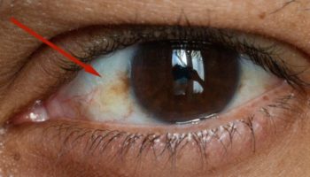 Picture When the White in Your Eyes Is Not Quite White, Should You Worry?