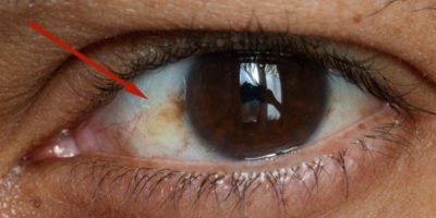 Picture When the White in Your Eyes Is Not Quite White, Should You Worry?