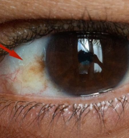 Picture When the White in Your Eyes Is Not Quite White, Should You Worry?