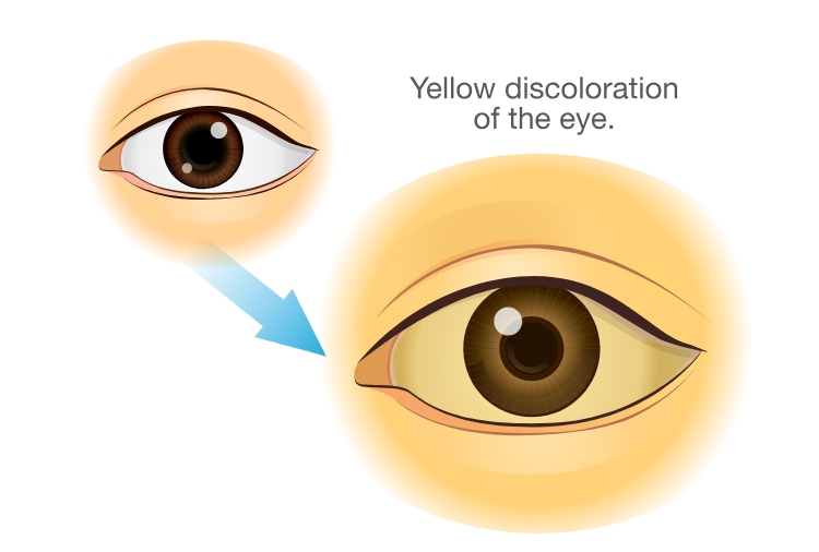 Yellow discoloration of the eyes