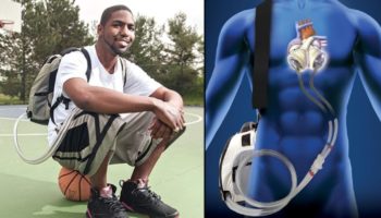 Picture Stan Larkin, The Man Who Lived Without a Heart for Over 500 Days