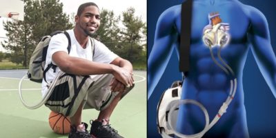 Picture Stan Larkin, The Man Who Lived Without a Heart for Over 500 Days