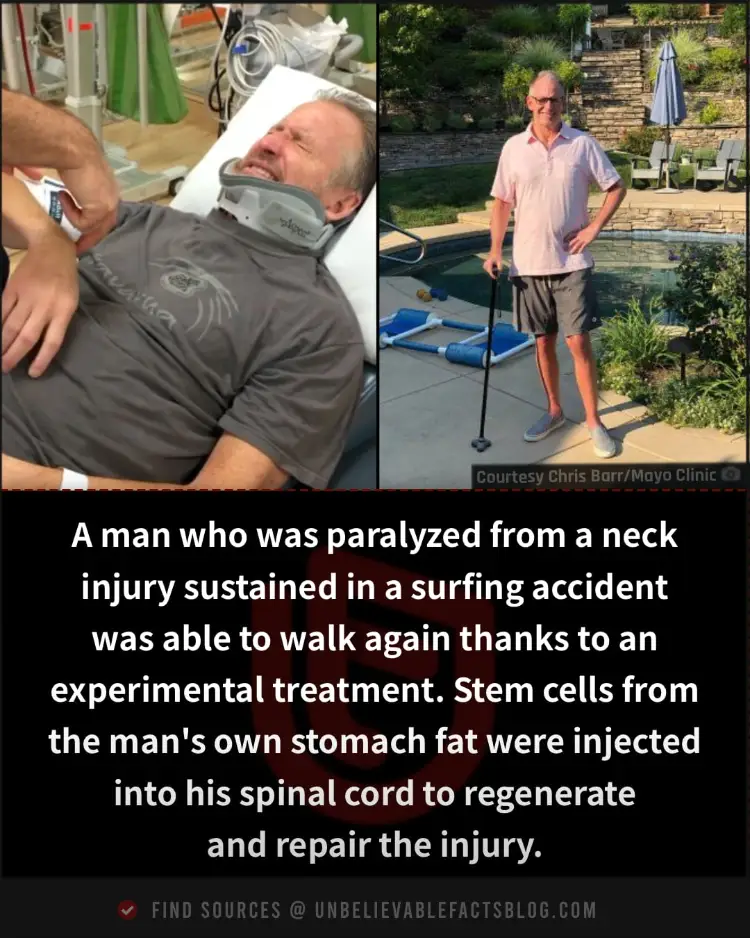 Paralyzed man walks again after experimental stem cell treatment success.