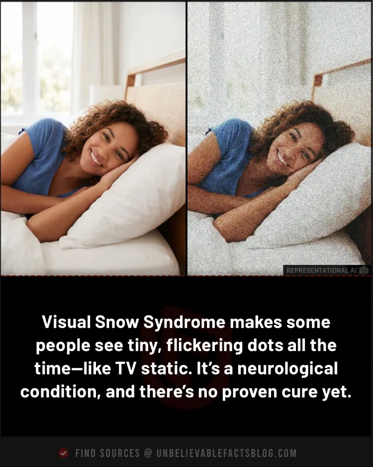 Visual snow syndrome Visual snow syndrome