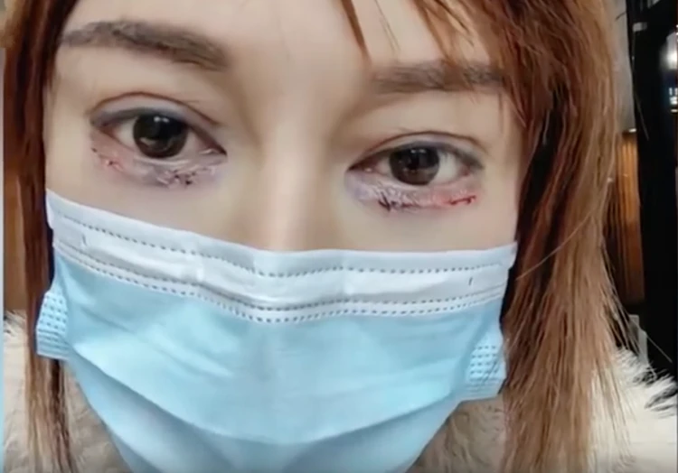 Ms. Zhang for double eyelid surgery