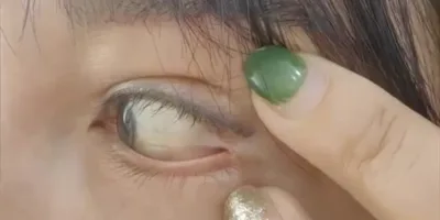 Picture Woman’s Eyeball and Eye Corner Sewn Together During Double Eyelid Surgery