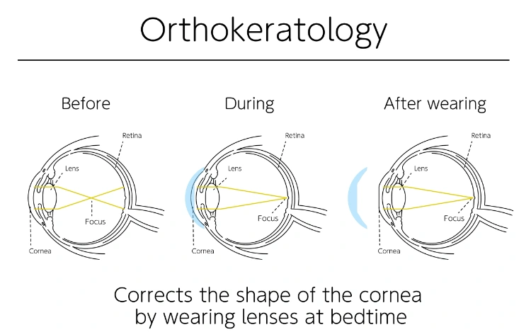 How ortho-k lenses reshape the cornea