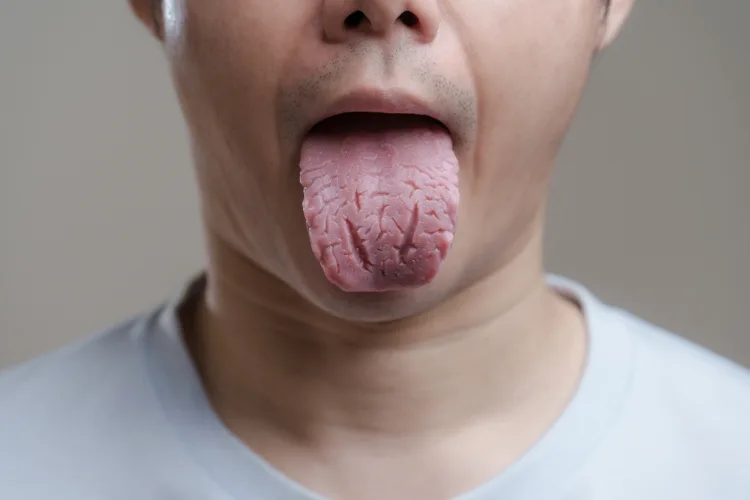 Fissured tongue