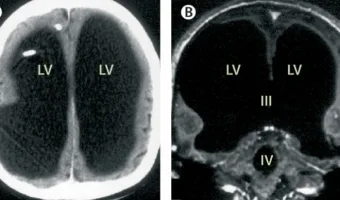 Picture Man Missing 90% of His Brain Lives a Normal Life