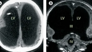 Picture Man Missing 90% of His Brain Lives a Normal Life
