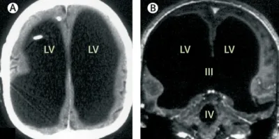 Picture Man Missing 90% of His Brain Lives a Normal Life