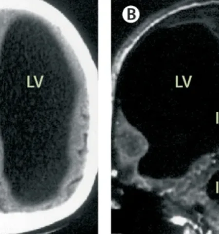 Picture Man Missing 90% of His Brain Lives a Normal Life