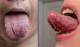 Picture Do Some People Really Have Tentacles Under Their Tongue?