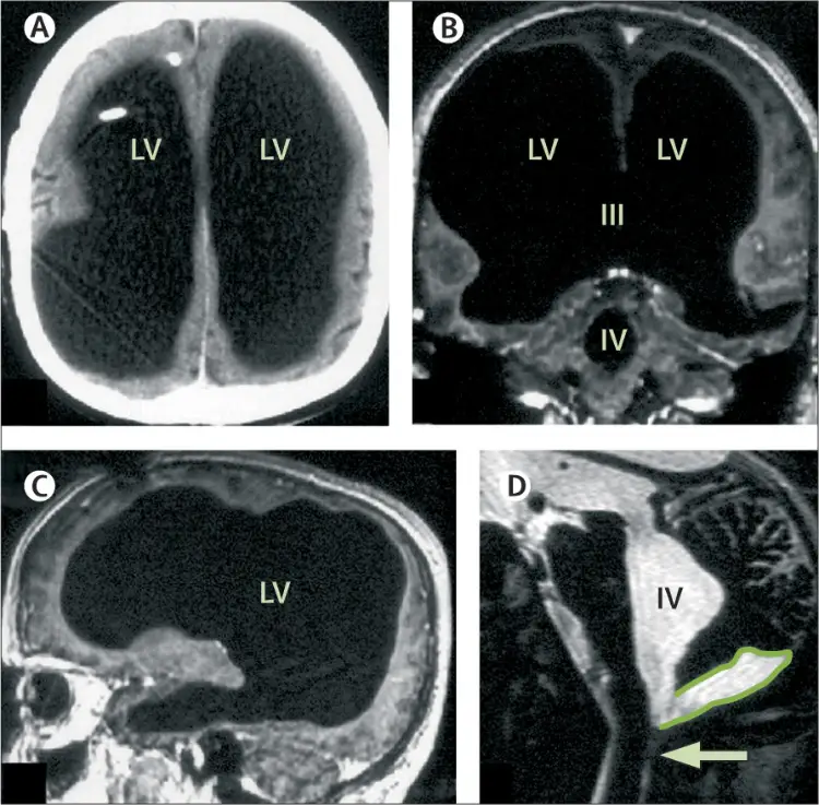 ventricular enlargement in brain