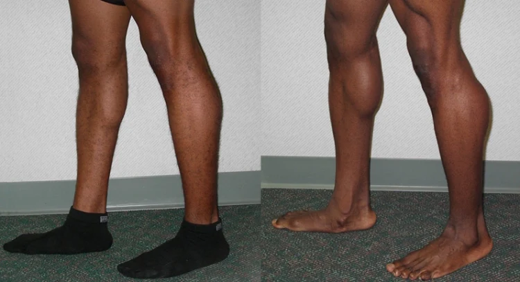 Calf-implant surgery