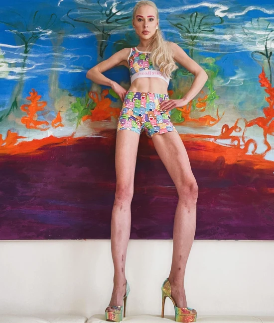 Leg-lengthening surgery