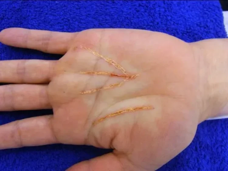 Palm-line surgery